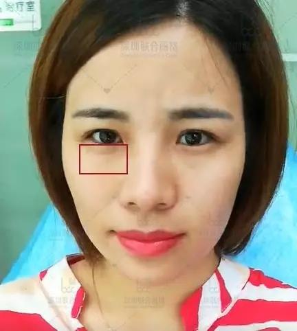 深圳聯(lián)合麗格:為什么明星一定要做熱瑪吉+線雕