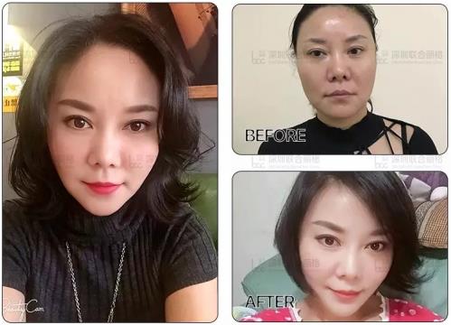 深圳聯(lián)合麗格:為什么明星一定要做熱瑪吉+線雕