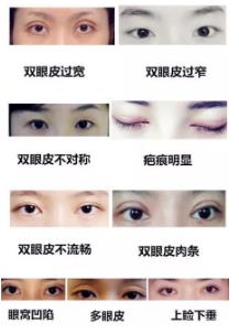 雙眼皮做失敗了?田永成醫(yī)美告訴你如何修復(fù)