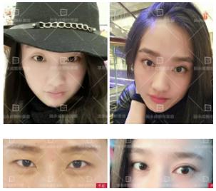 雙眼皮做失敗了?田永成醫(yī)美告訴你如何修復(fù)