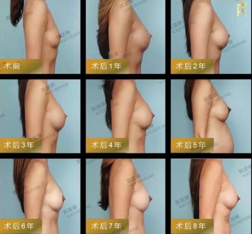 佛山凱瑟琳:第十屆微創(chuàng)豐胸圓滿謝幕!