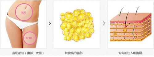 自體脂肪移植成活率常見問題有哪些?