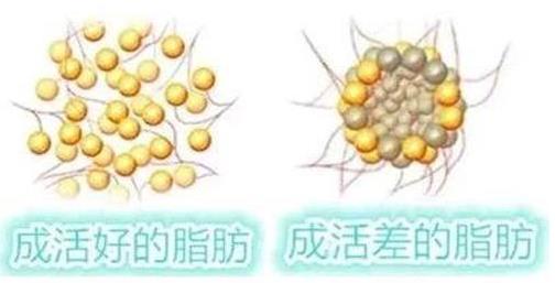 自體脂肪移植成活率常見問題有哪些?