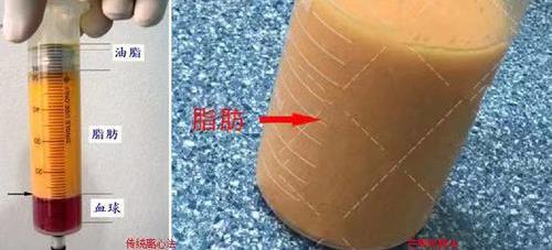 自體脂肪移植成活率常見問題有哪些?