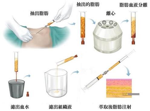自體脂肪移植成活率常見問題有哪些?