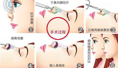 煤醫(yī)整形王馳主任:并不是什么人都適合鼻綜合手術(shù)