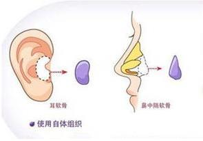 煤醫(yī)整形王馳主任:鼻梁高但鼻頭塌,可以考慮耳軟骨墊鼻尖