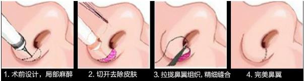 北京煤醫(yī)整形醫(yī)院王馳主任:鼻翼整形你了解多少