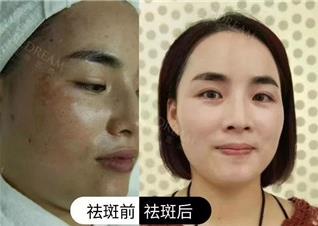 寧波薇琳整形醫(yī)院祛斑好嗎?讓你重獲年輕靚麗