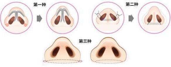 北京煤醫(yī)整形醫(yī)院王馳主任:鼻翼整形你了解多少