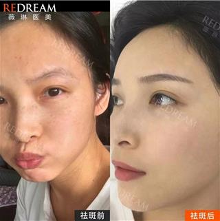 寧波薇琳整形醫(yī)院祛斑好嗎?讓你重獲年輕靚麗