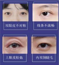 田永成:眼睛無神可通過眼部整形有效提升