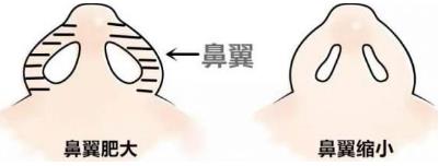 北京彤美整形醫(yī)院桂行軍說:你的鼻子缺陷是哪幾個?