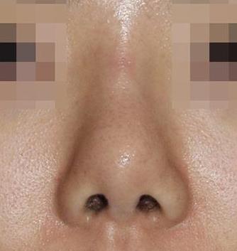 北京彤美整形醫(yī)院桂行軍說:你的鼻子缺陷是哪幾個?
