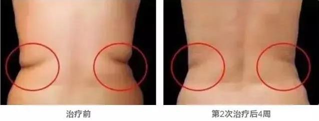 武漢藝星整形醫(yī)院:6月22-28日酷塑減脂專場,讓你輕輕松松的減肥!