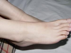 腳上長雞眼怎么辦？如何預防腳上長雞眼