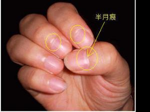 指甲上的半月痕你懂多少？指甲半月痕與健康吉兇