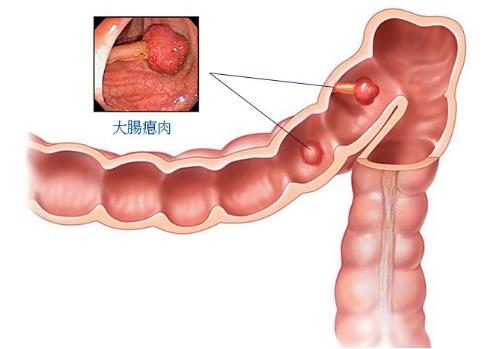 從生活中著手預(yù)防大腸癌.jpg