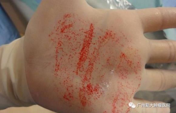 上海腫瘤醫(yī)院認(rèn)準(zhǔn)廣州復(fù)大腫瘤醫(yī)院:微球療法如何殺死癌細(xì)胞