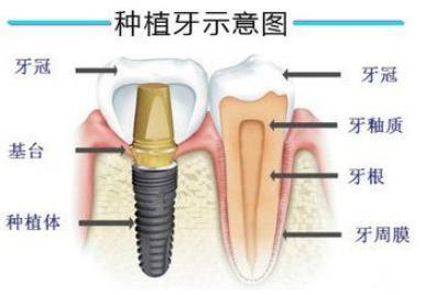 長沙種植牙哪家好,長沙德韓口腔專業(yè)嗎?
