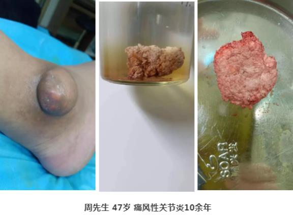 濟(jì)南中醫(yī)風(fēng)濕病醫(yī)院中醫(yī)微創(chuàng)針刀鏡技術(shù)在痛風(fēng)性關(guān)節(jié)炎中臨床應(yīng)用