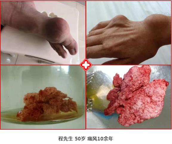 濟(jì)南中醫(yī)風(fēng)濕病醫(yī)院中醫(yī)微創(chuàng)針刀鏡技術(shù)在痛風(fēng)性關(guān)節(jié)炎中臨床應(yīng)用