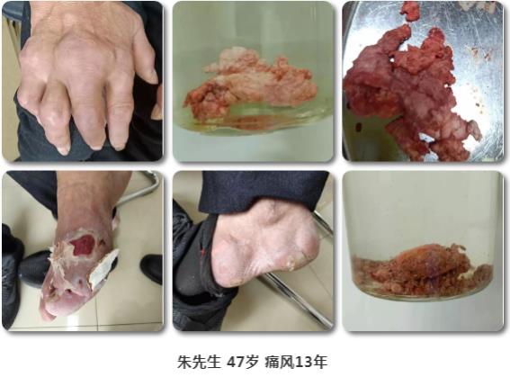 濟(jì)南中醫(yī)風(fēng)濕病醫(yī)院中醫(yī)微創(chuàng)針刀鏡技術(shù)在痛風(fēng)性關(guān)節(jié)炎中臨床應(yīng)用