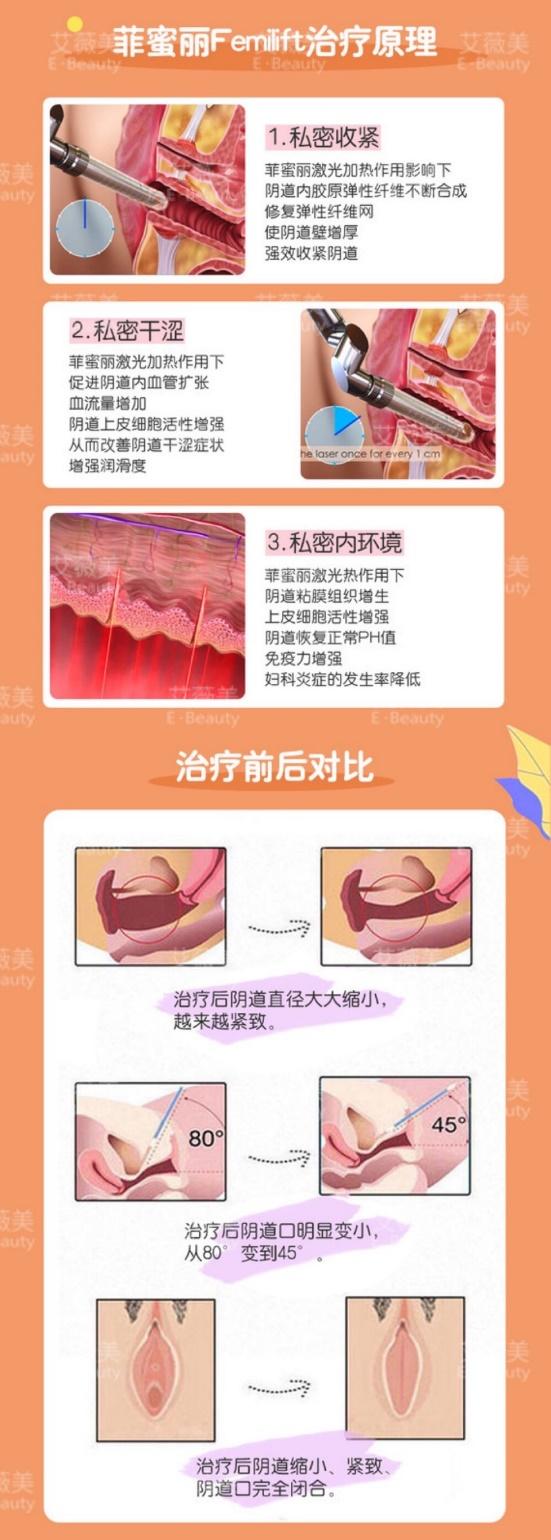 西安艾薇美女性整復(fù) 開展私密微整提升女性生活質(zhì)量