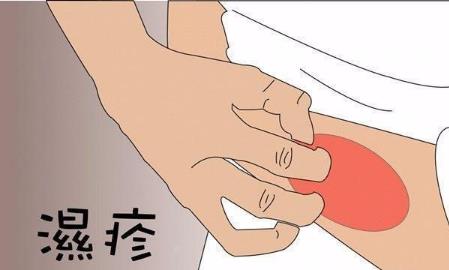 長(zhǎng)濕疹不一定是壞事?人一旦得了濕疹就一輩子有嗎
