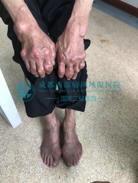 在成都西部痛風(fēng)風(fēng)濕醫(yī)院即可預(yù)約上海風(fēng)濕免疫科博導(dǎo)