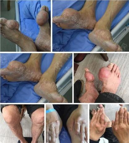 在成都西部痛風(fēng)風(fēng)濕醫(yī)院即可預(yù)約上海風(fēng)濕免疫科博導(dǎo)