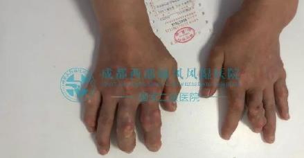 在成都西部痛風(fēng)風(fēng)濕醫(yī)院即可預(yù)約上海風(fēng)濕免疫科博導(dǎo)