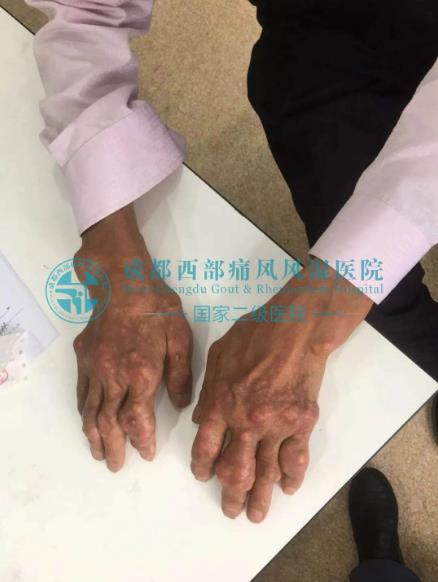 在成都西部痛風(fēng)風(fēng)濕醫(yī)院即可預(yù)約上海風(fēng)濕免疫科博導(dǎo)