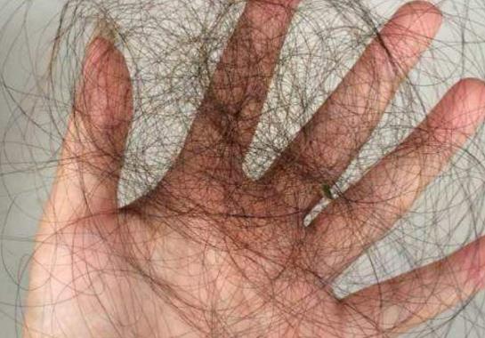 女人脫發(fā)的原因有哪些?女人脫發(fā)怎么辦?