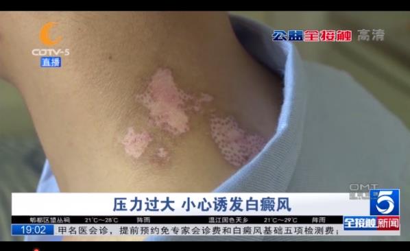 小伙勞改后突發(fā)白癜風(fēng),積極治療傳遞正能量