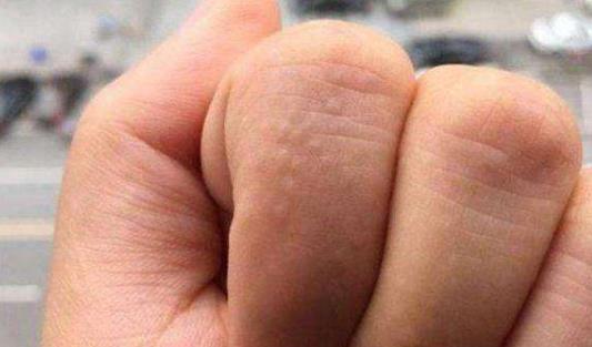 手上的小水泡是什么?手上長小水泡的原因有哪些?