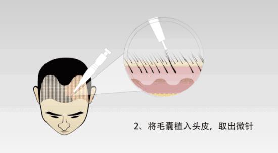 激動(dòng)!揚(yáng)州大麥微針植發(fā)即將盛大開業(yè),超100萬發(fā)友翹首以待!
