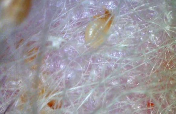 虱子為什么會咬人?身上生虱子怎么辦?如何能預(yù)防生虱子?