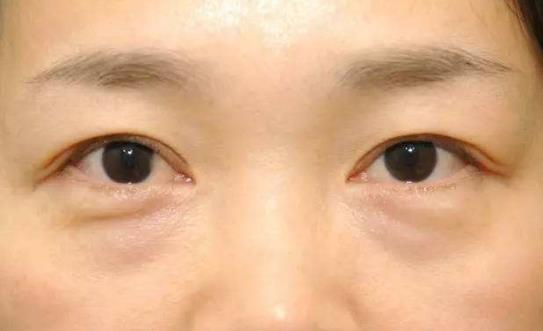 眼袋發(fā)黑的原因有哪些?為什么眼袋會疼?