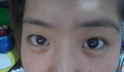 眼袋也分類型,怎么快速消除眼袋?