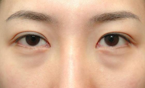 眼袋也分類型,怎么快速消除眼袋?