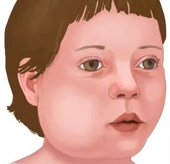 腮腺炎有哪些癥狀?腮腺炎如何護理?