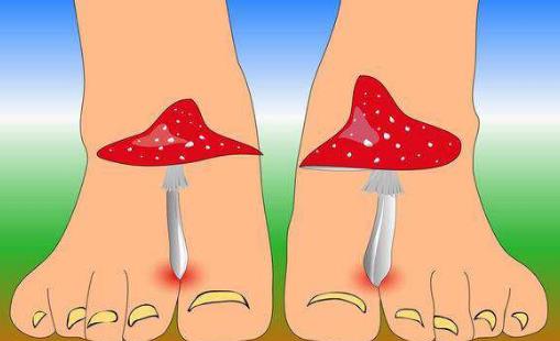 腳氣是病嗎?腳氣重怎么辦?