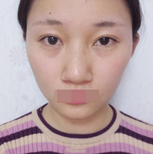寧波玲瓏整形醫(yī)院解讀:除了忌口,做隆鼻也沒有我想的那么麻煩!