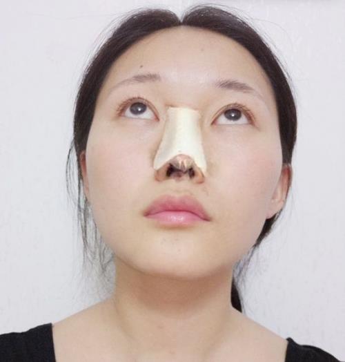 寧波玲瓏整形醫(yī)院解讀:除了忌口,做隆鼻也沒有我想的那么麻煩!