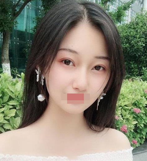 寧波玲瓏整形醫(yī)院解讀:除了忌口,做隆鼻也沒有我想的那么麻煩!