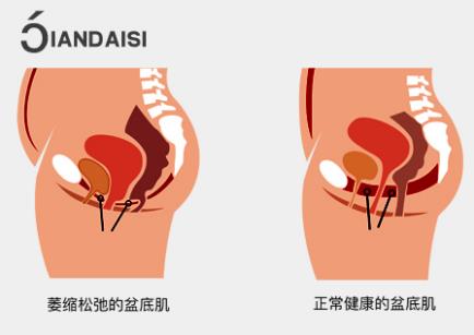 產(chǎn)后松弛怎么才能變緊致?二胎媽媽的自述!