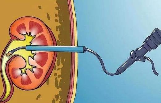 腎積水需要做哪些檢查?腎積水的治療有哪些?