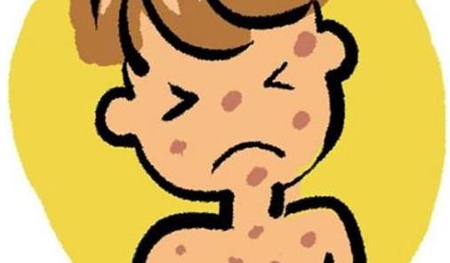 患了麻疹有哪些并發(fā)癥?怎么預防麻疹?