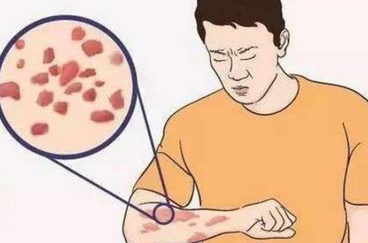 什么是蕁麻疹?患蕁麻疹的因素有哪些?